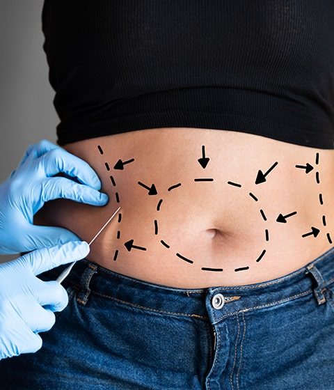 Abdominoplastia: Saiba tudo sobre a cirurgia e a recuperação