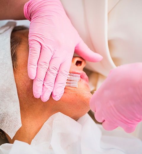Foto-Procedimento-Fio-de-Sustentacao-Facial